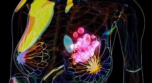 Prokineticin-2 כסמן פרמקודינמי פוטנציאלי להתמודדות עם עמידות לדוקסורוביצין בספרואידים רב-תאיים של סרטן שד